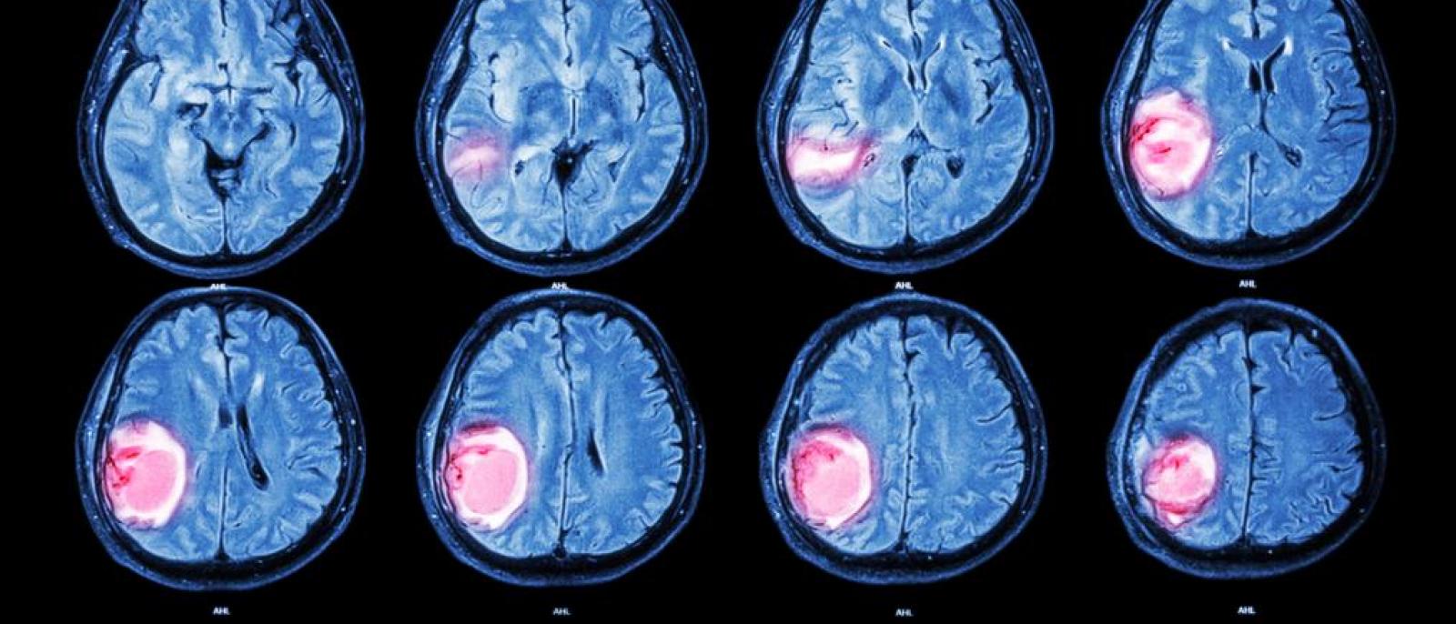 One in Five Brain Cancers Fueled by Overactive Mitochondria